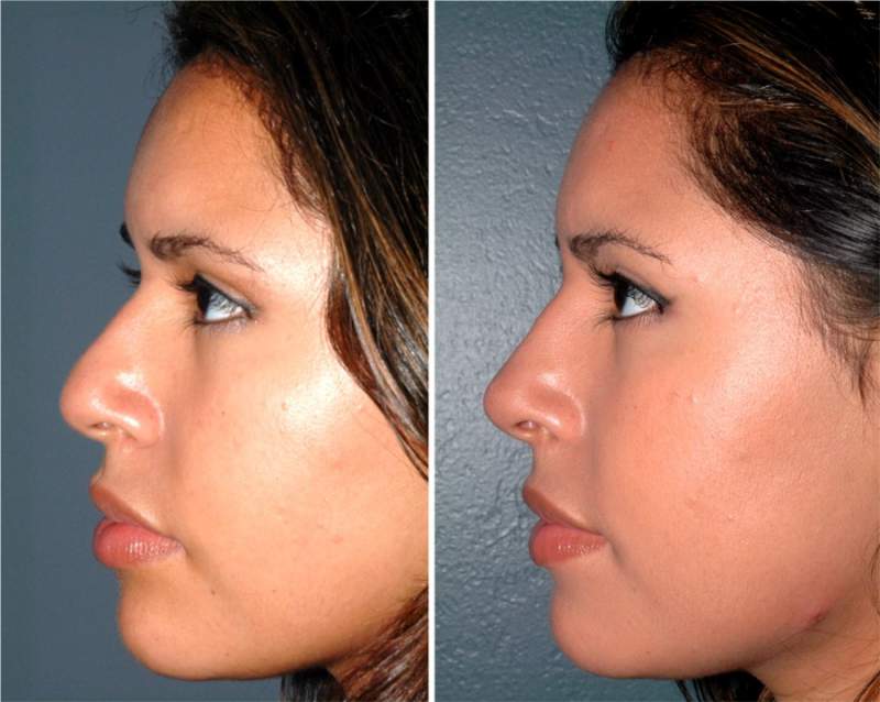rinoplastika