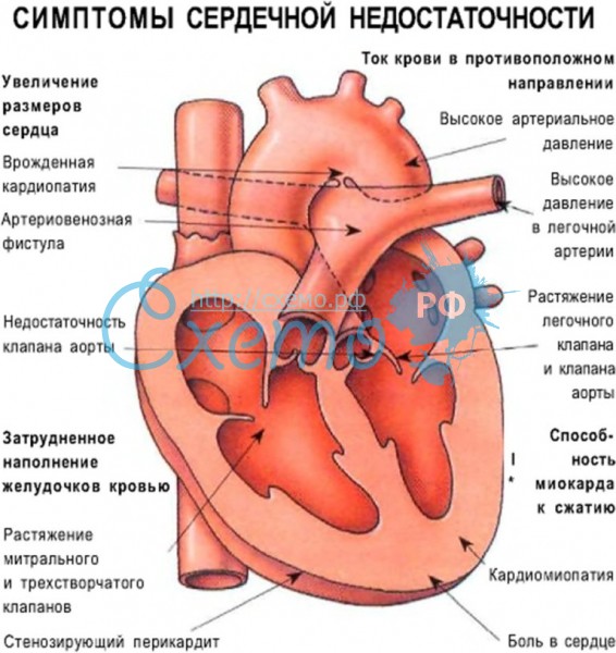 Выявление сердечной недостаточности по анализу крови