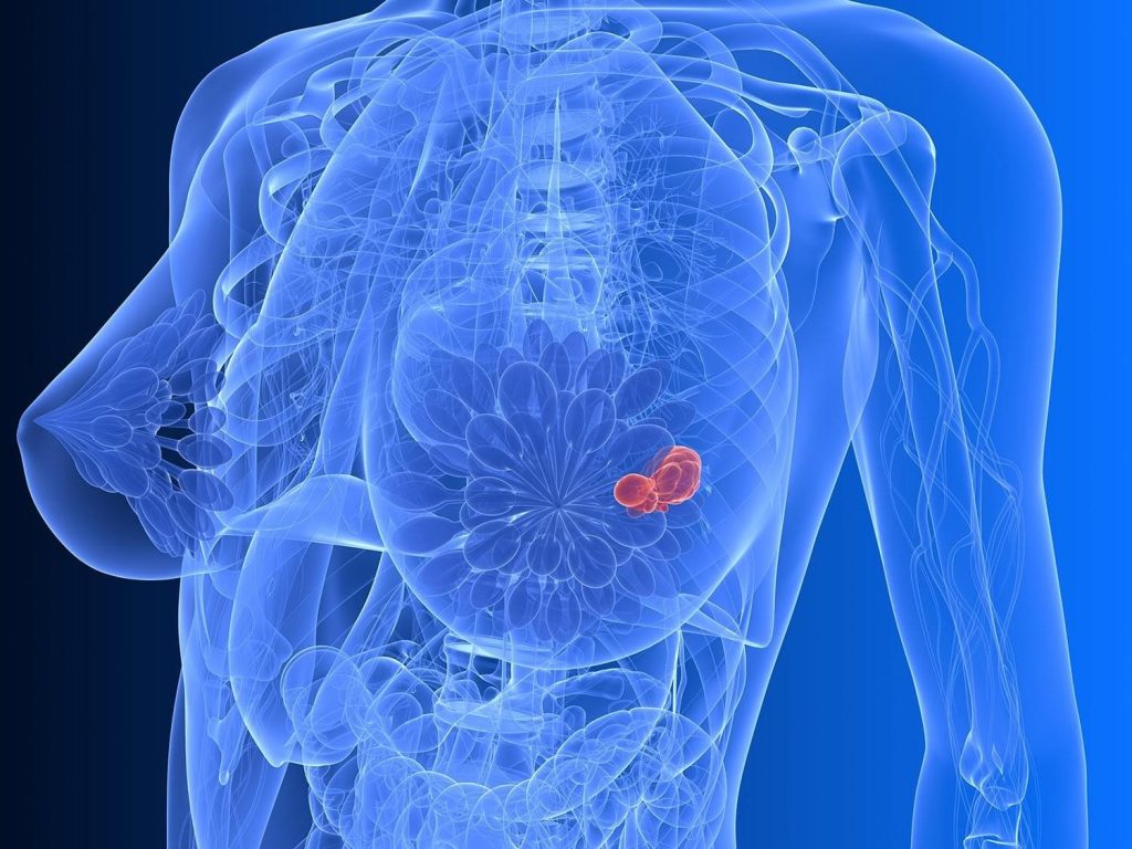 Рак молочной железы: факторы риска, самообследование и диагностика