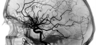 Ангіографія судин головного мозку